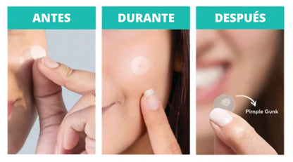 Acne Patch™ Parche para espinillas e imperfecciones