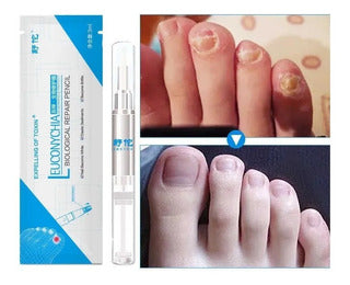 FEETMAX™-Lápiz reparador de uñas