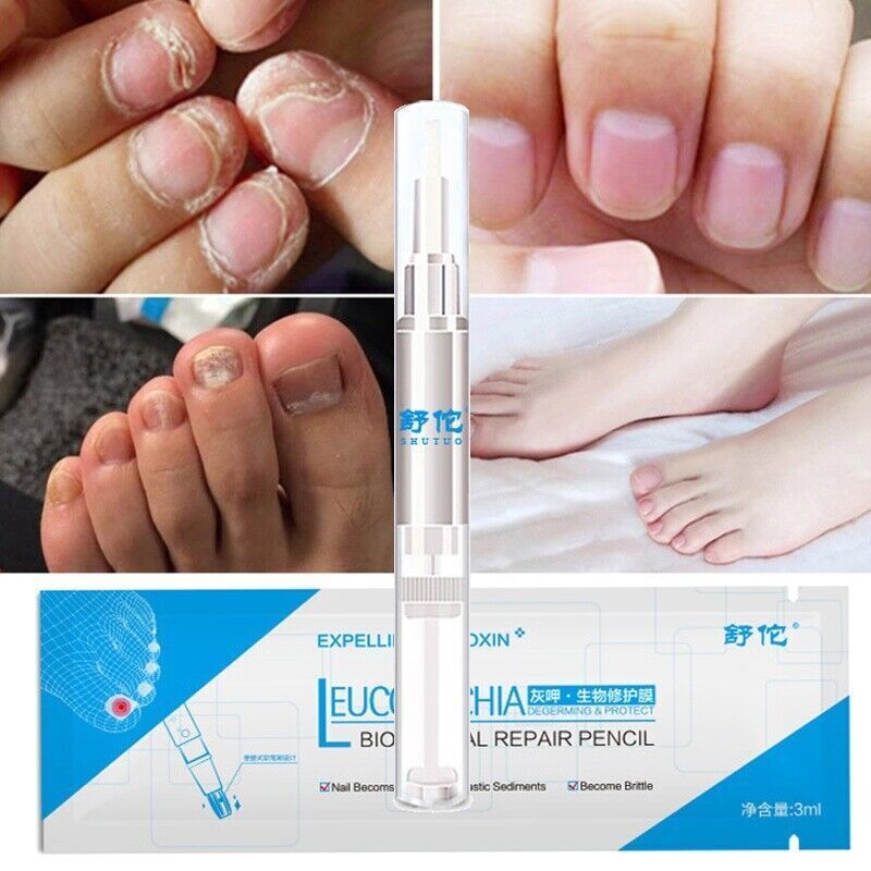 FEETMAX™-Lápiz reparador de uñas